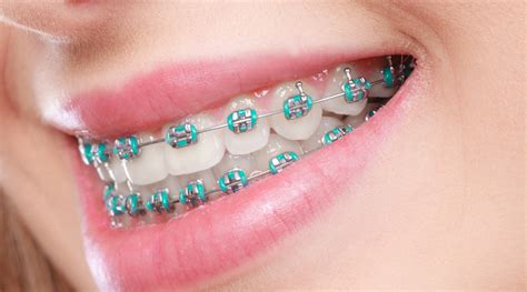 metal brackets in orthodontics|pictures of traditional steel braces.